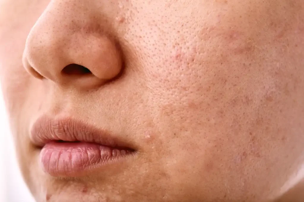 Face with Skin Imperfections and Problems