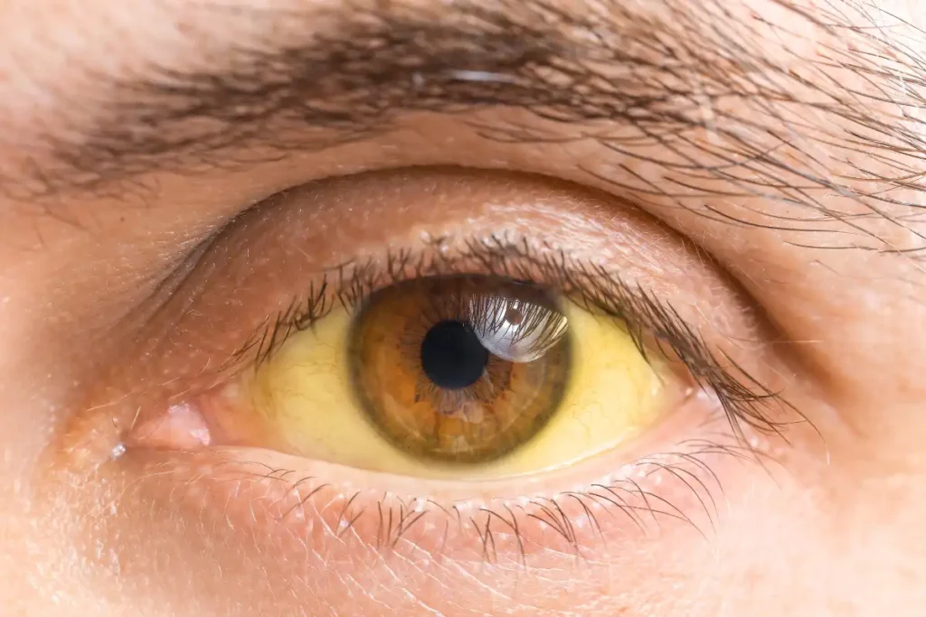 Yellowing of the skin or eyes (jaundice)